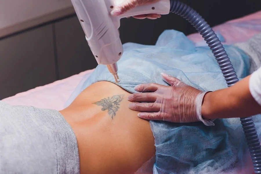 Tattoo Removal