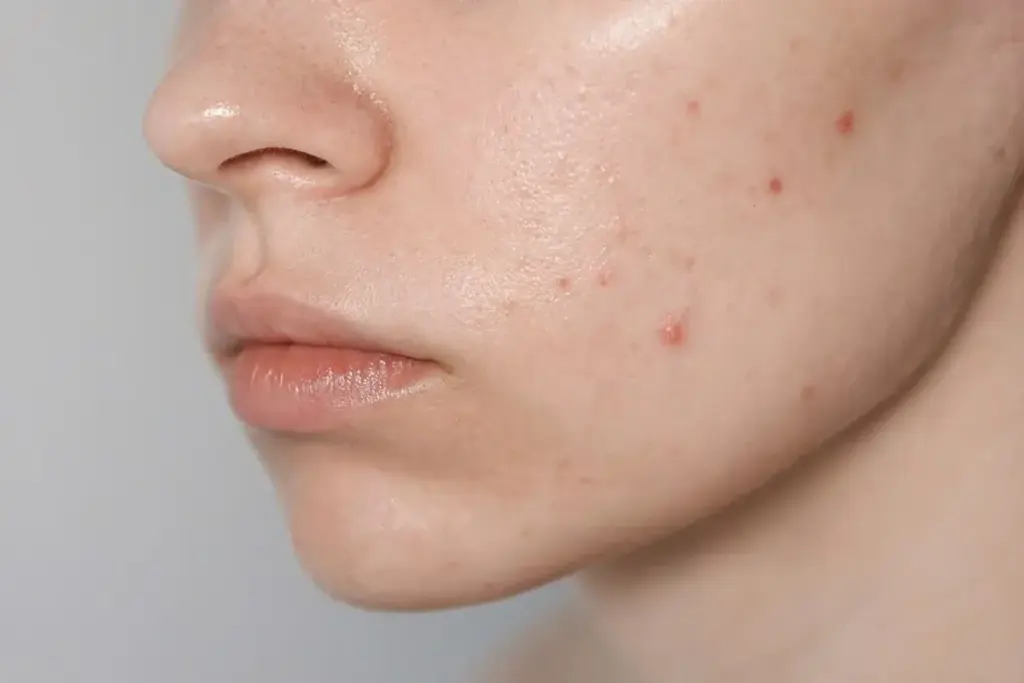 Acne Spot Corrector: Shrink Blind Pimples Over a Single Night 